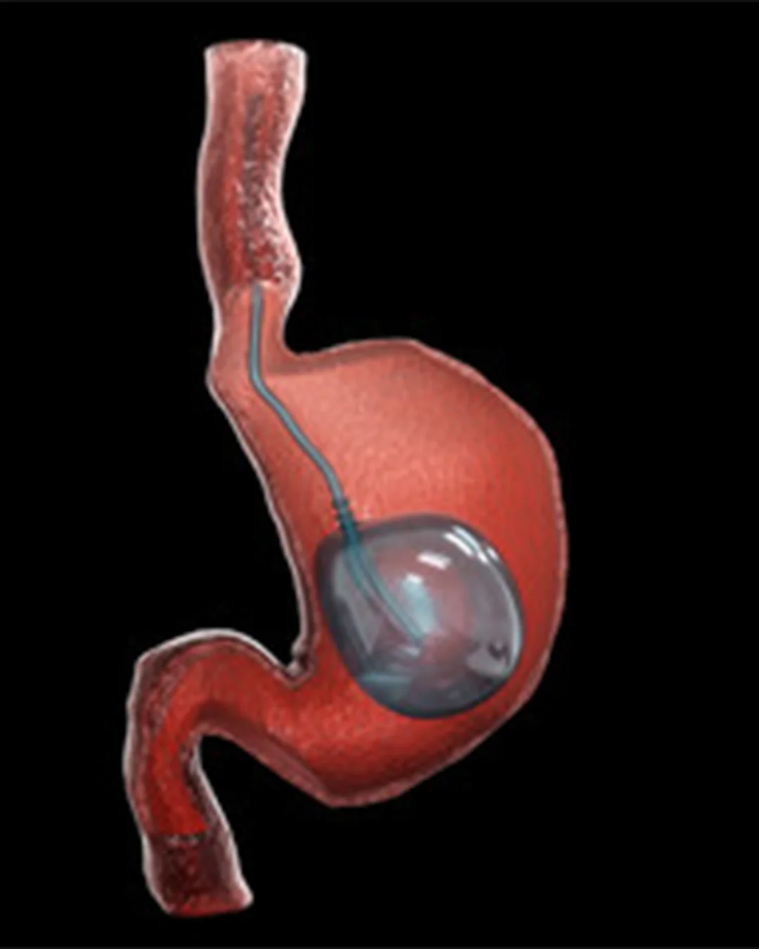 Çfarë është një tullumbace gastrike?