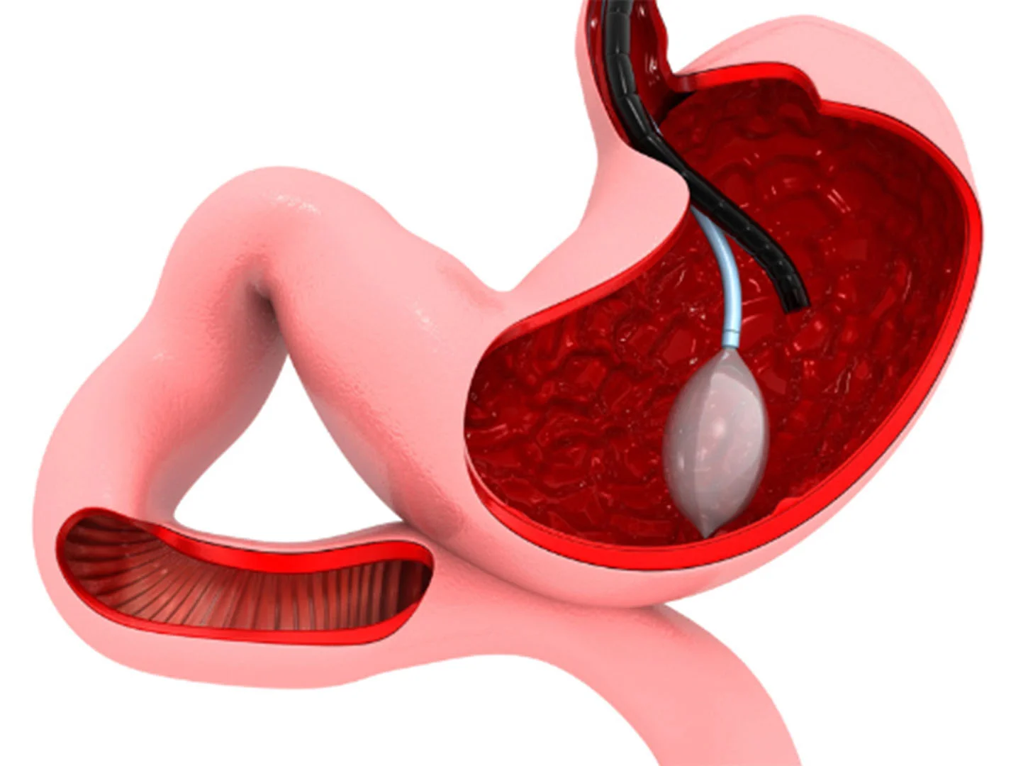 Balonë gastrike në Stamboll Care
