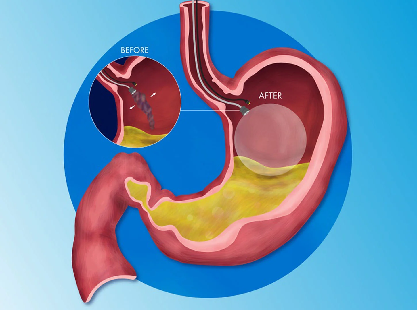 Sa peshë mund të pres të humbas?