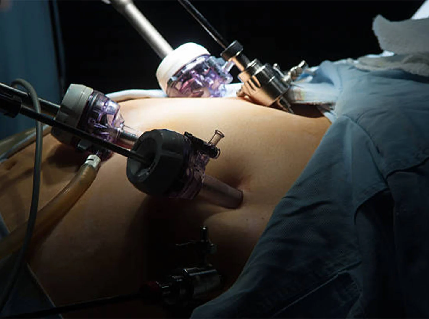 Komme ich für eine Magenbypass in Betracht?