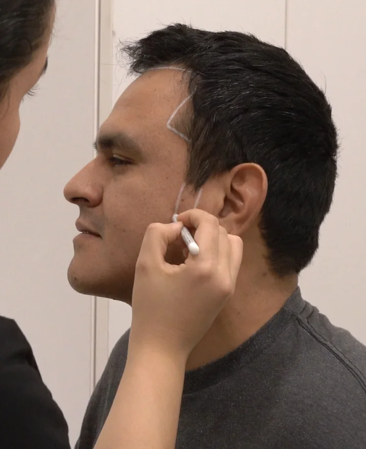 Consultation pour une greffe de poils de barbe en Turquie