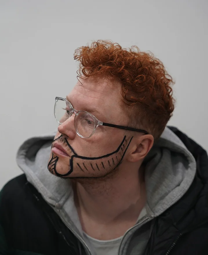 Procédure de greffe de barbe étape par étape