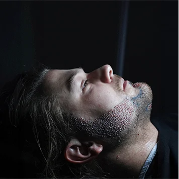 Transplante de barba