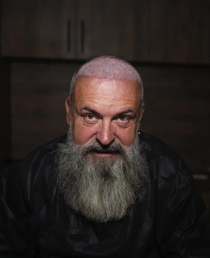 Benefits over older transplant methods like FUT