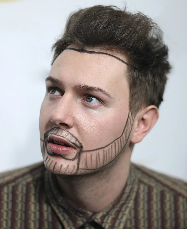 Confort et Effets Secondaires Après une Greffe de Barbe