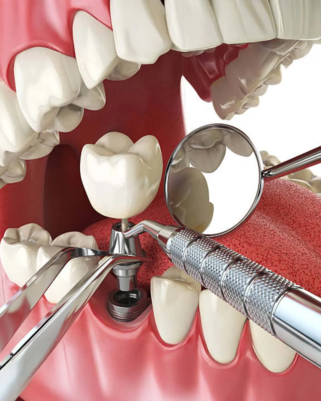 Tratament în caz de eșec al implantului dentar