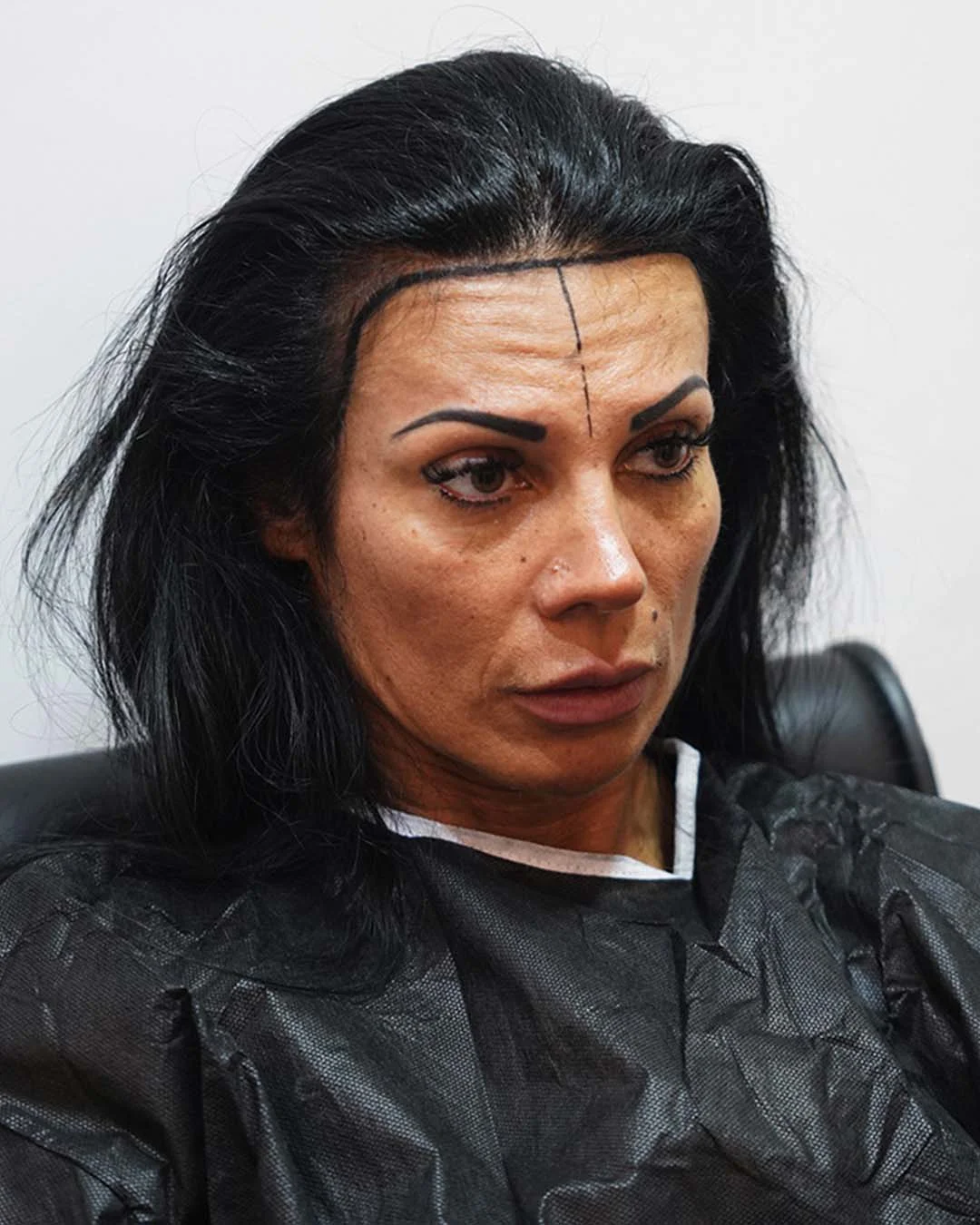 Procedura de transplant de păr pentru femei