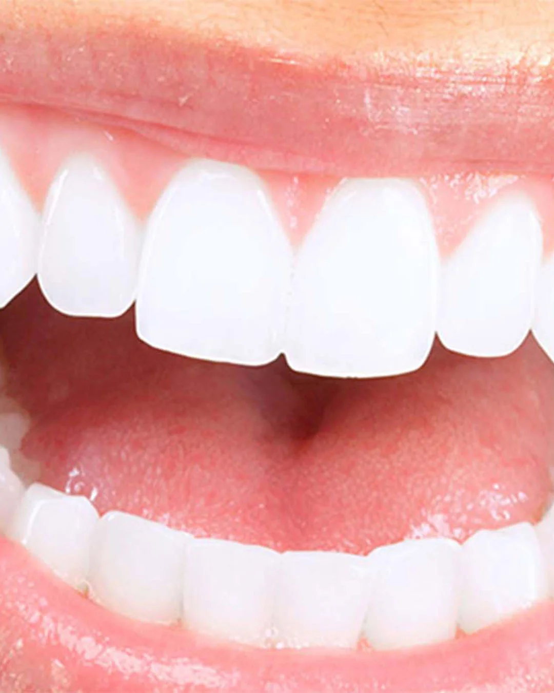 O procedimento de um sorriso hollywoodiano