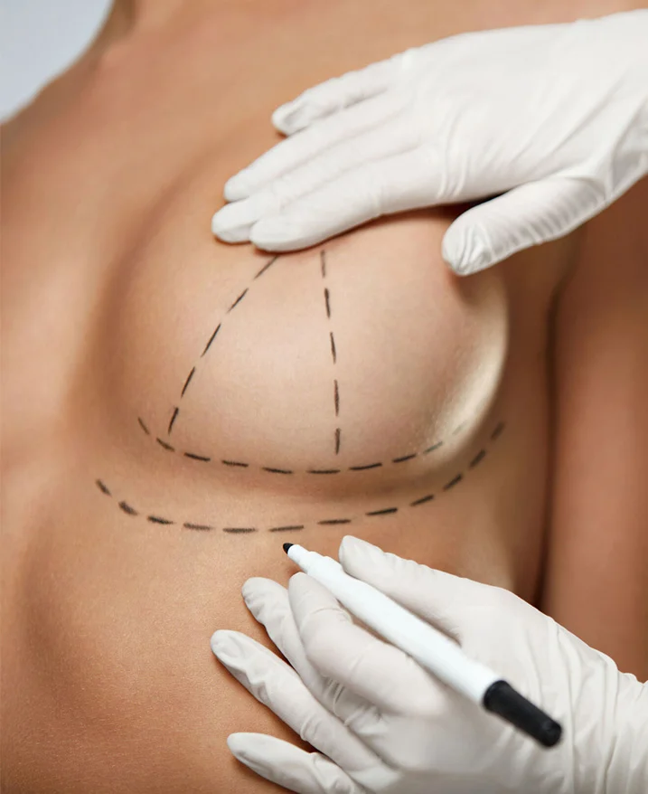 Comment se déroule une augmentation mammaire ?