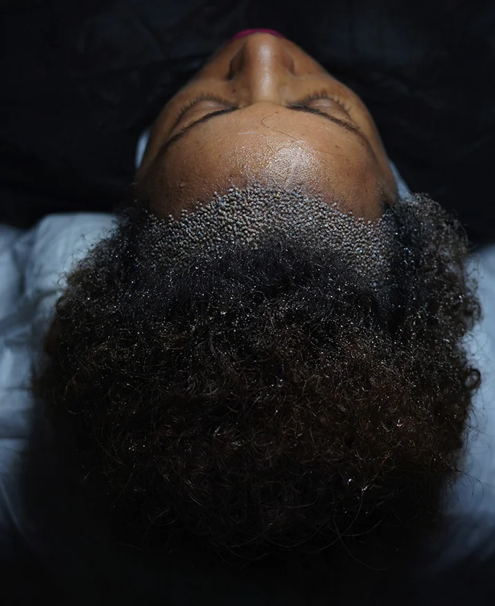 ¿Cuánto tiempo duran los resultados de un trasplante de cabello afro?