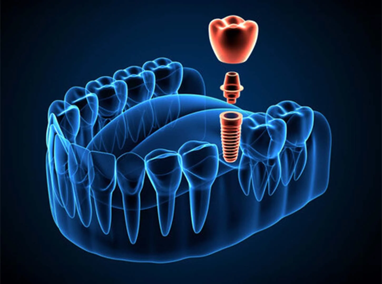 De câte implanturi dentare voi avea nevoie?