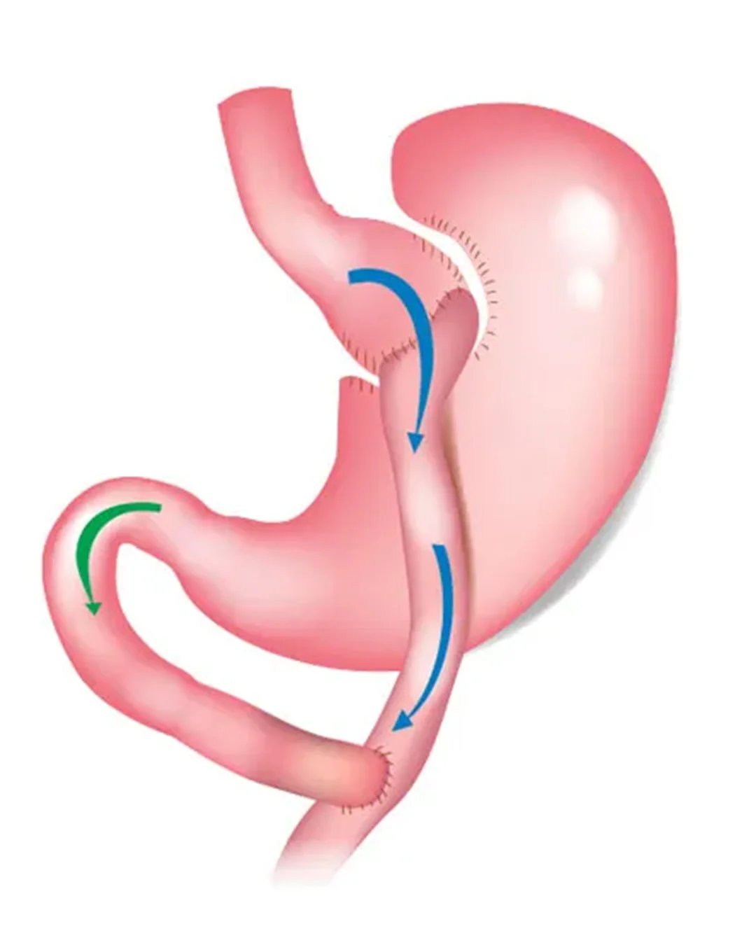 So funktioniert die Operation