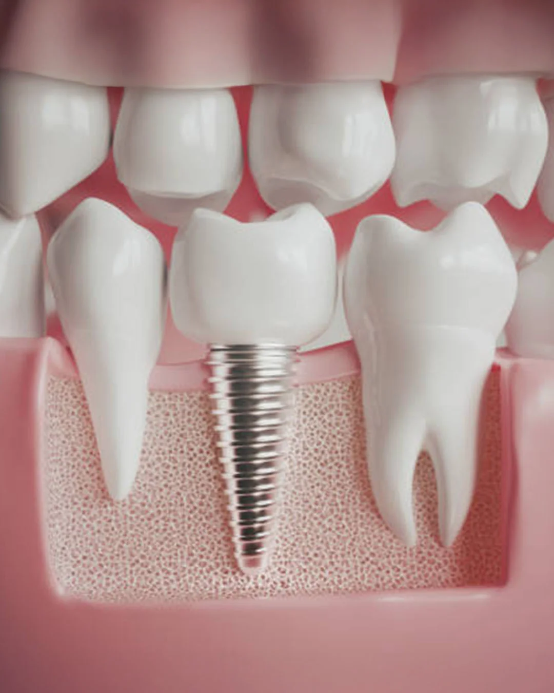 Tratamentul implantului în Istanbul Care