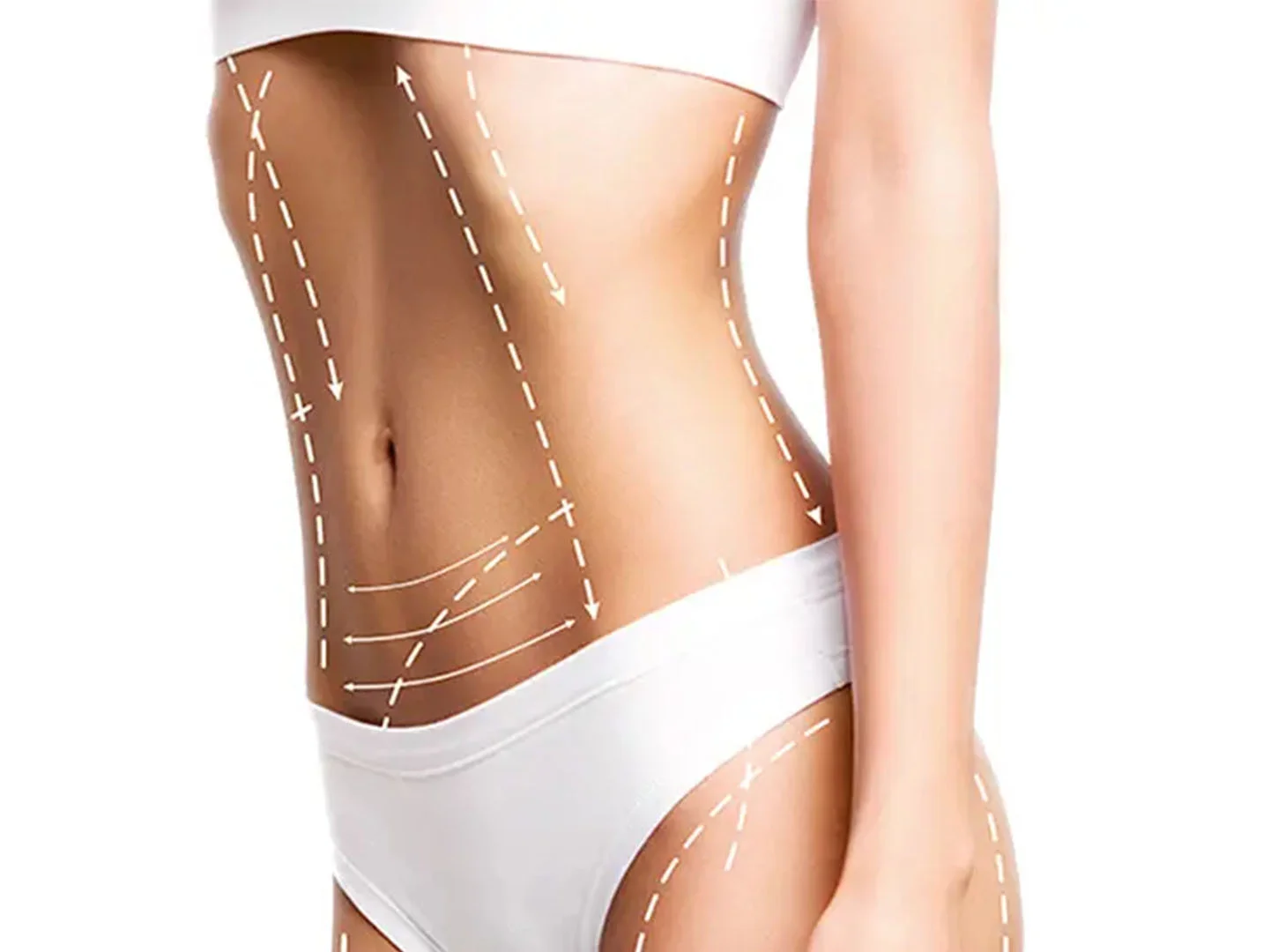 Mega liposuction in Istanbul Care