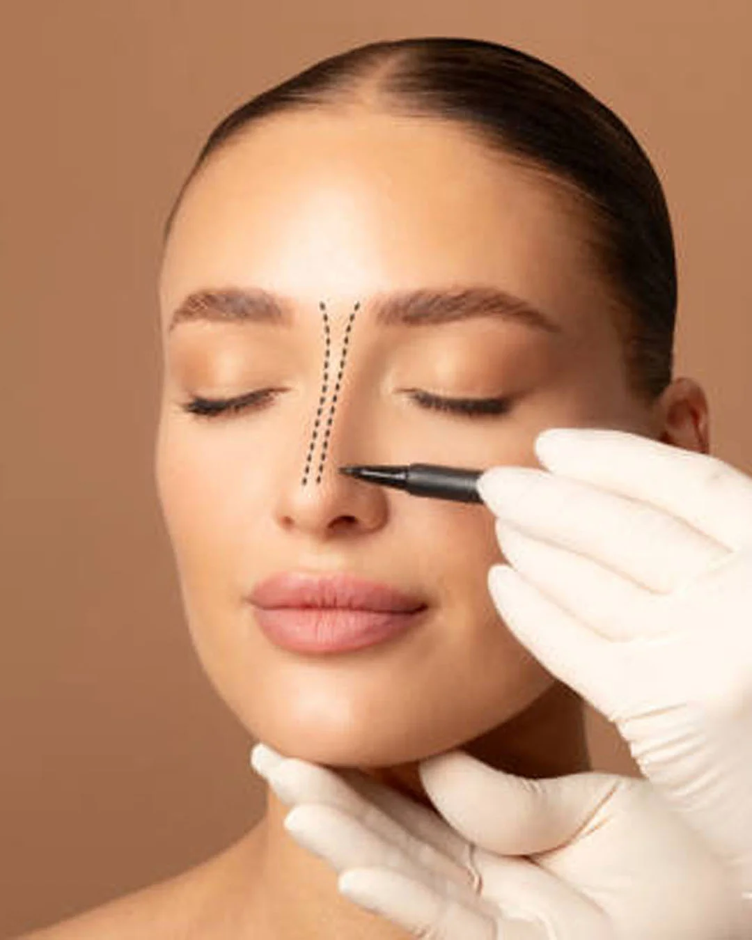 Techniques de rhinoplastie ouverte et fermée