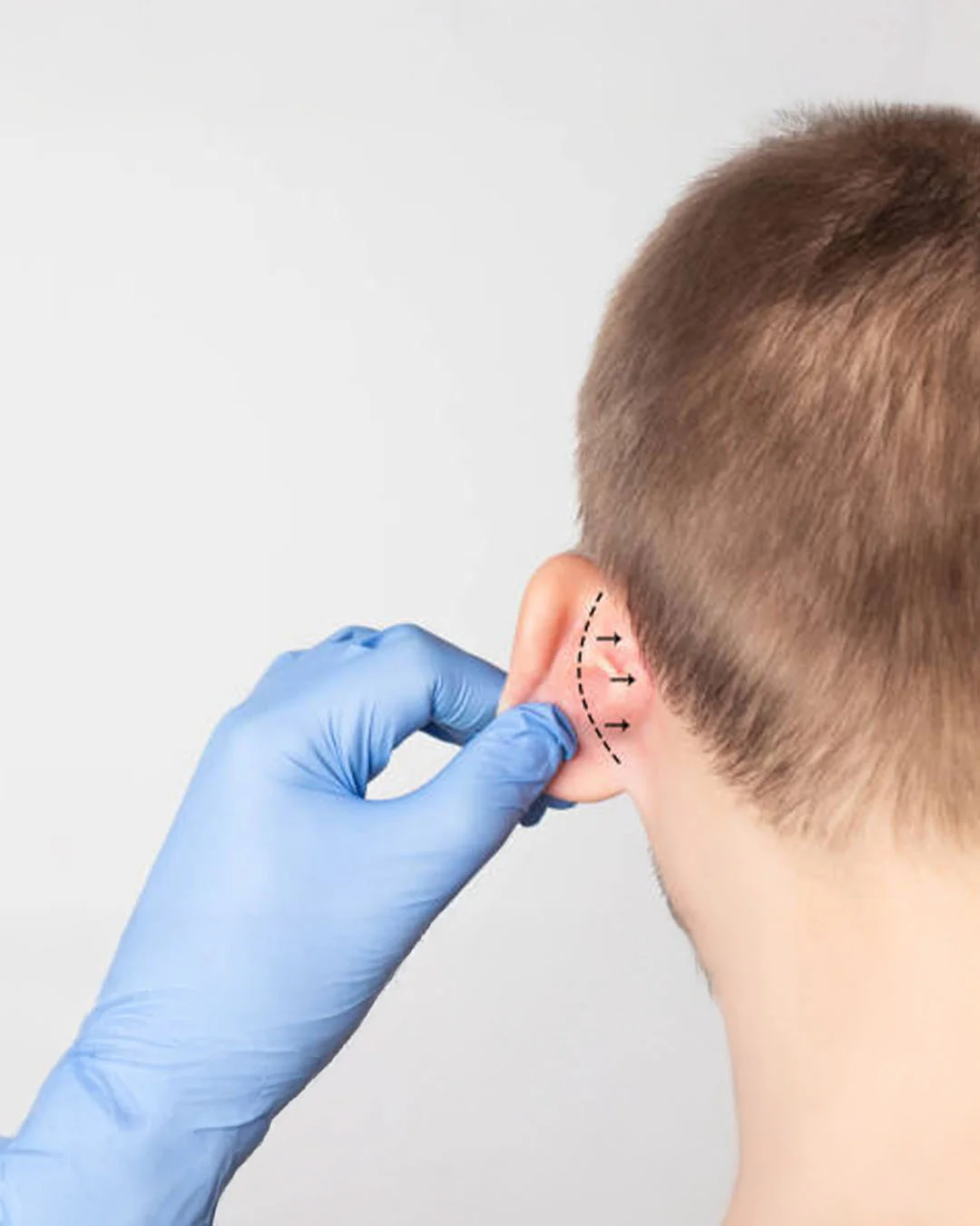 Erholungszeit der Otoplastik