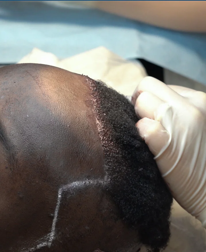 Experiencia del paciente desde la preoperatoria hasta el crecimiento completo