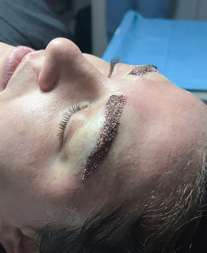 Precyzyjne umiejscowienie przeszczepu dla naturalnego wzorca wzrostu