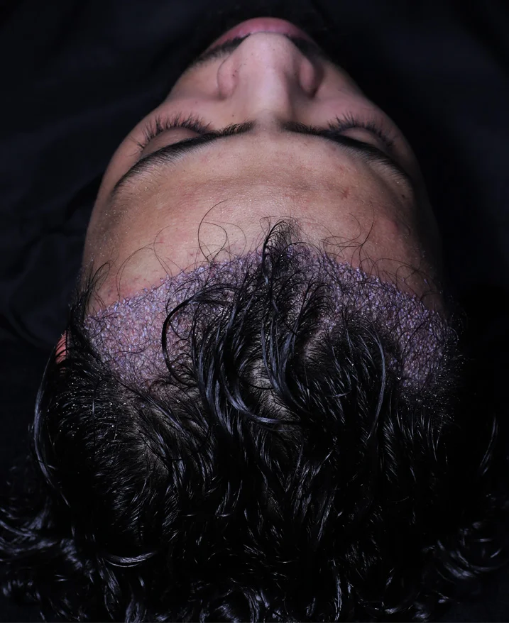 Zeitplan für die Genesung nach Ihrer DHI-Haartransplantation