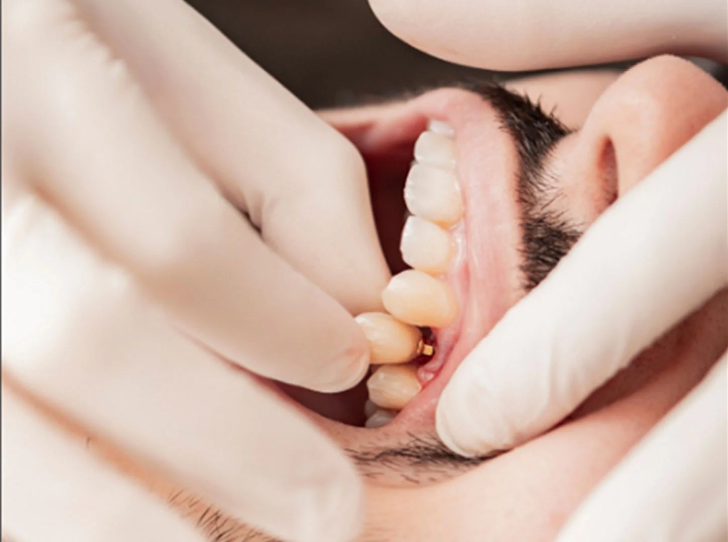 Procedura chirurgicala a implantului dentar