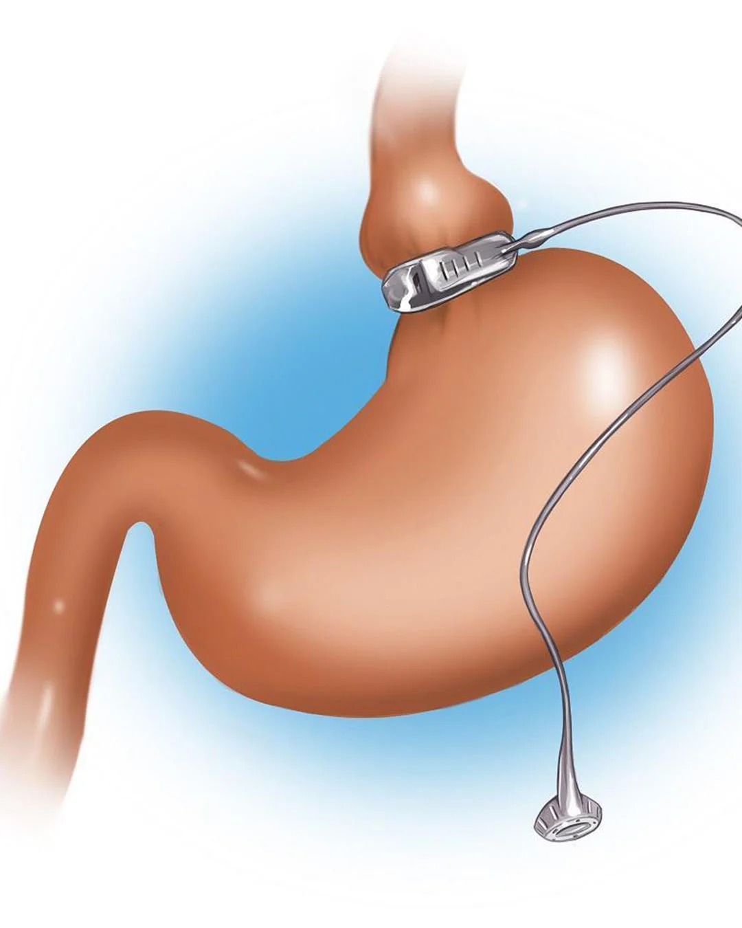 Der Vorteil des LAP-BAND-Systems