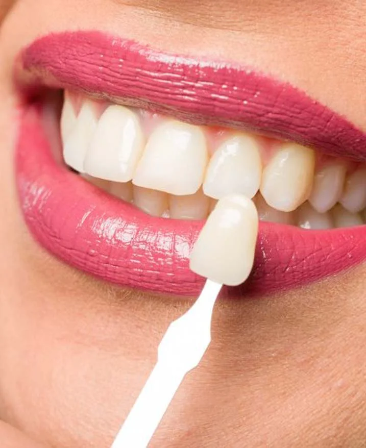 Transform Your Smile with E-max Veneers