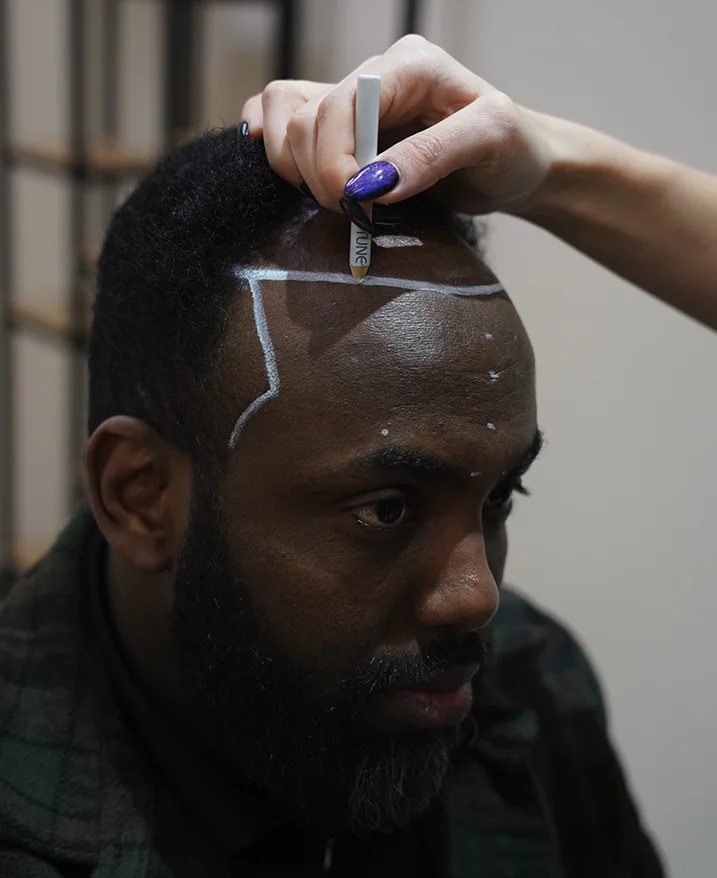 Tratamiento de la calvicie de patrón masculino en cabello afro