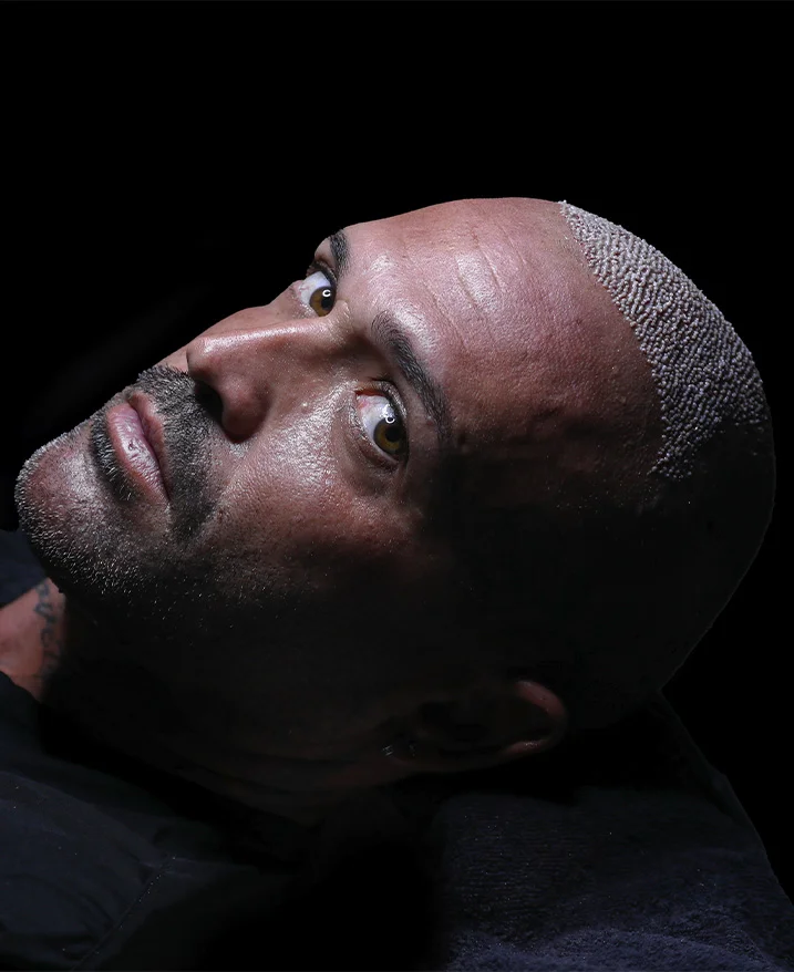 Région donneuse de coupe et début de l'anesthésie