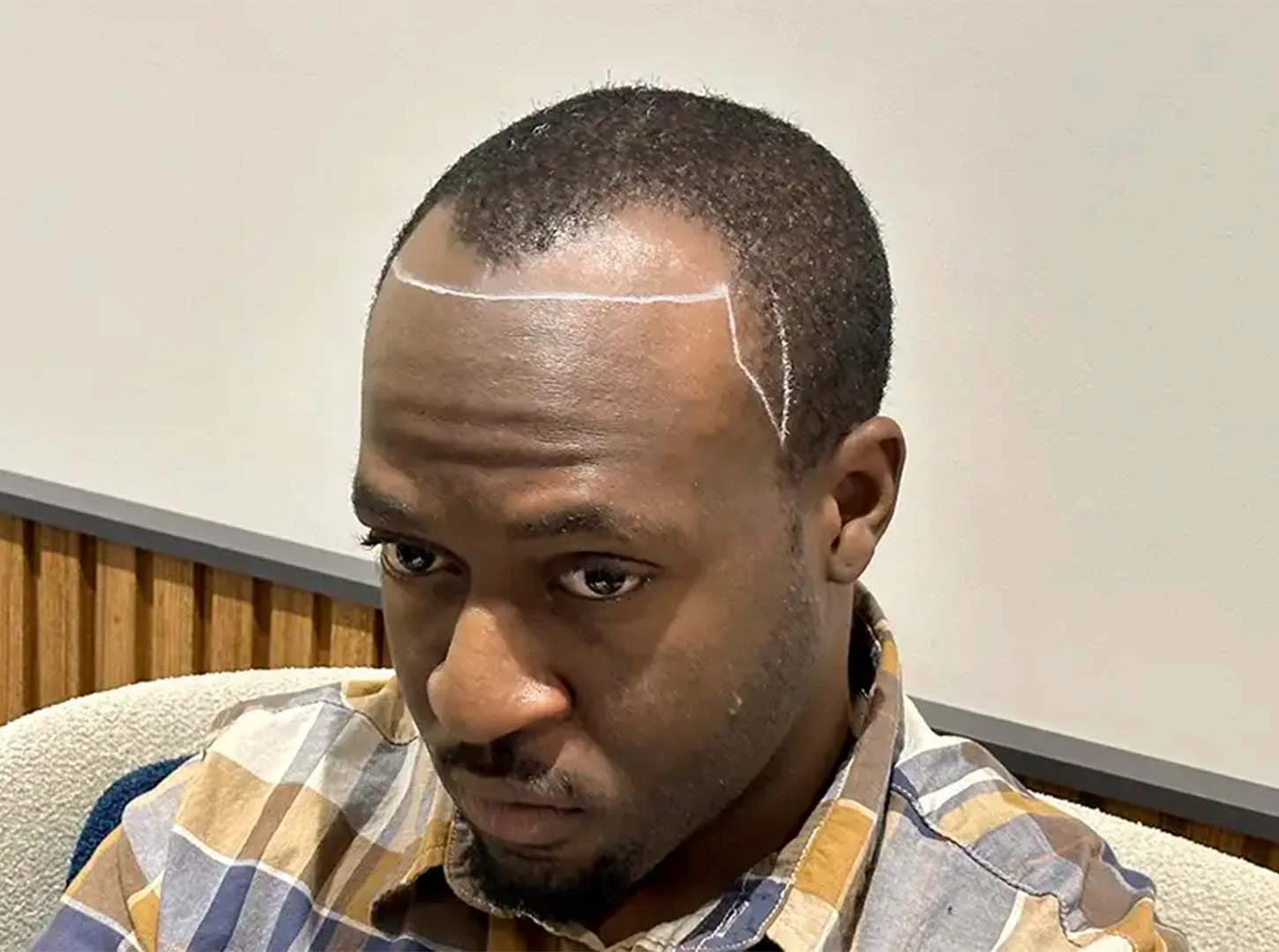 Informazioni di base sul trapianto di capelli afro