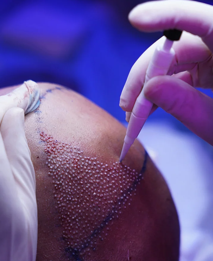 Verständnis der Technik der direkten Haarimplantation