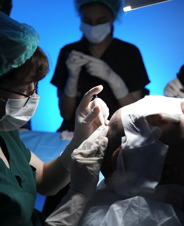 Verwendung von DHI zur Wiederherstellung von Bart oder Augenbrauen