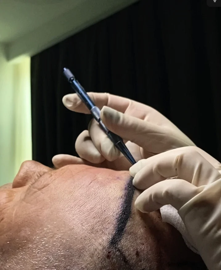 Die Verwendung von FUE-Motoren zur Entnahme von Transplantaten