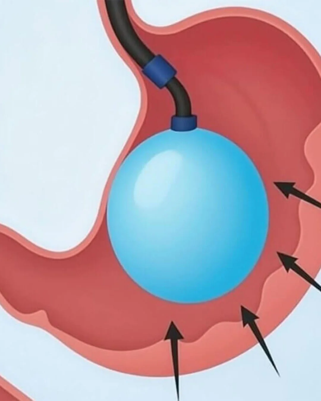 Çfarë ndodh pas procedurës?