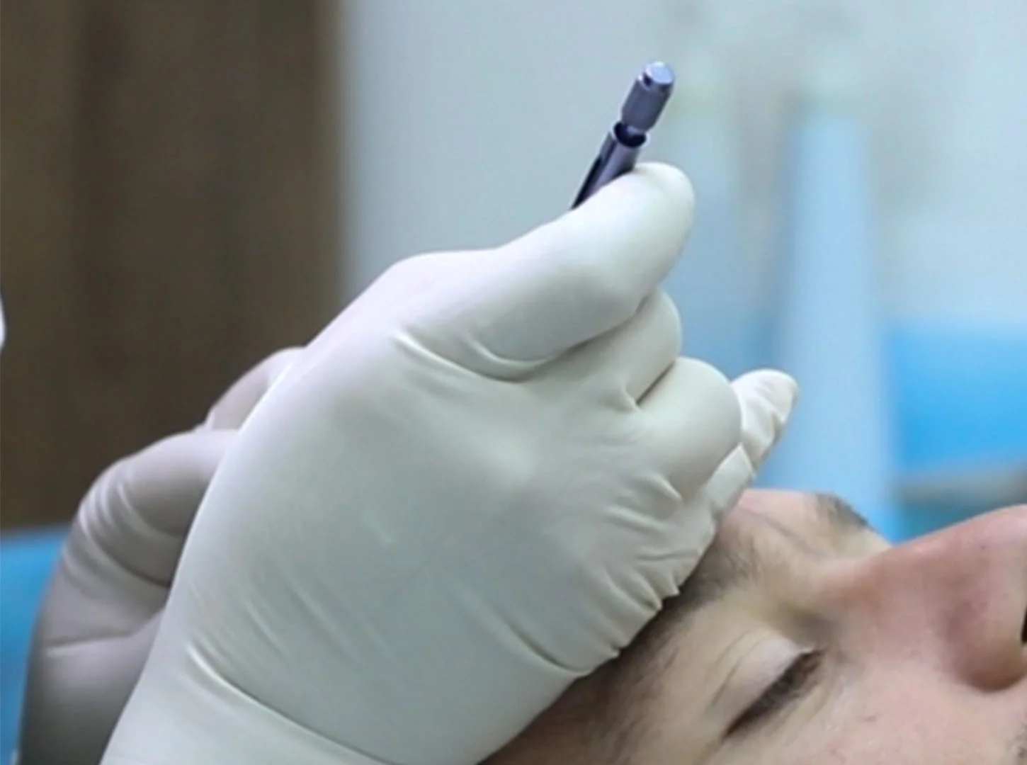 Técnica de trasplante capilar fue de zafiro