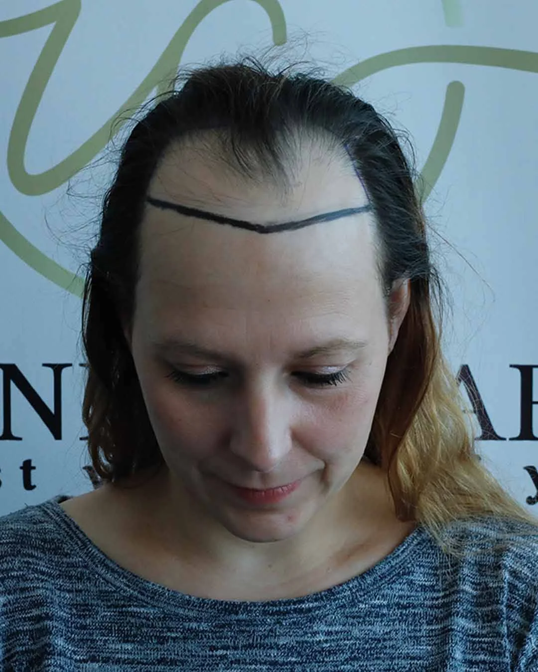 Ce este un serviciu de transplant de păr pentru femei