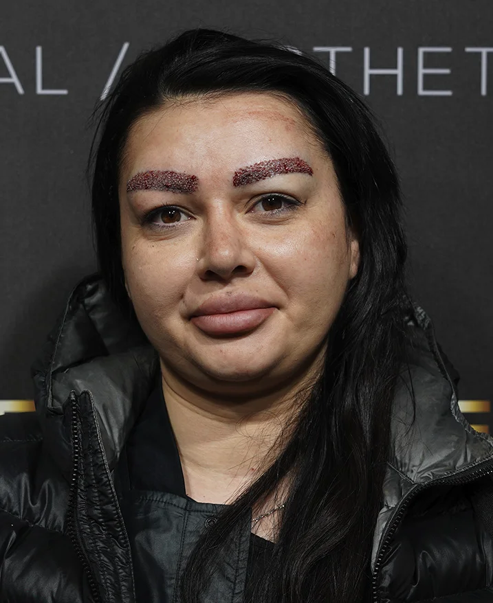 Czego można się spodziewać w okresie rekonwalescencji po leczeniu