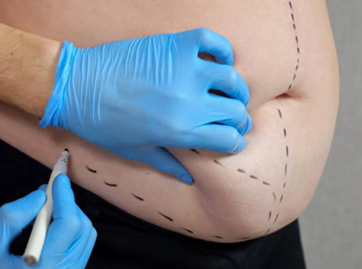 Quelle est la première étape de la liposuccion en Turquie ?