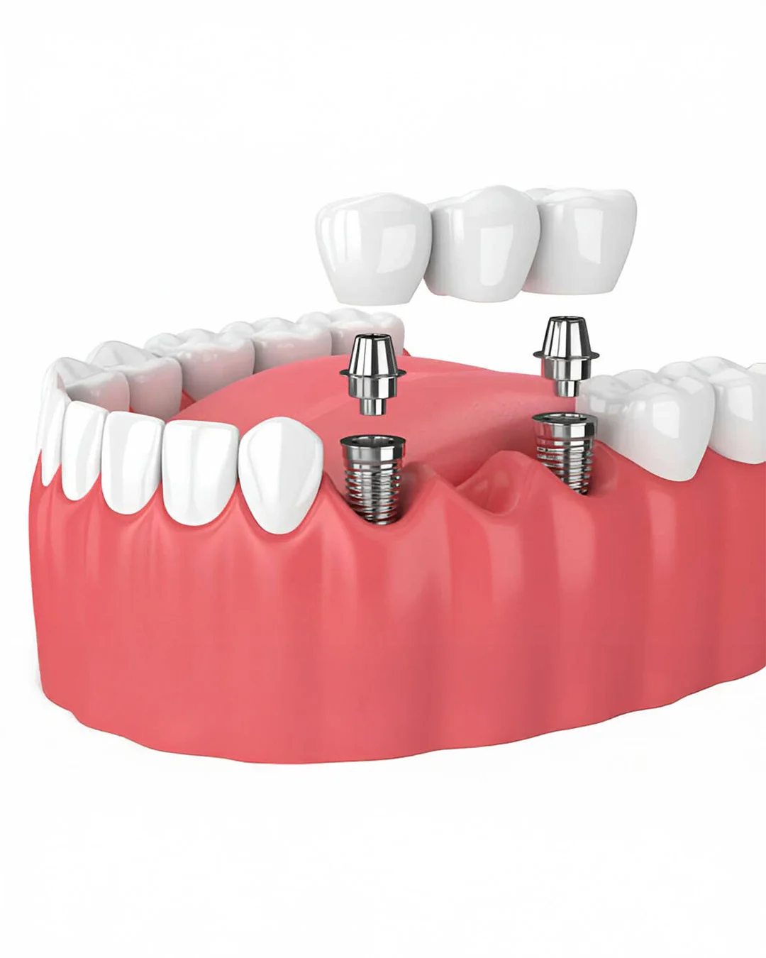 De ce să alegeți implanturile dentare în locul protezelor dentare tradiționale sau a punților dentare?
