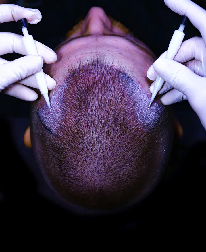 Warum die Option, sich nicht zu rasieren, für viele Patienten attraktiv ist