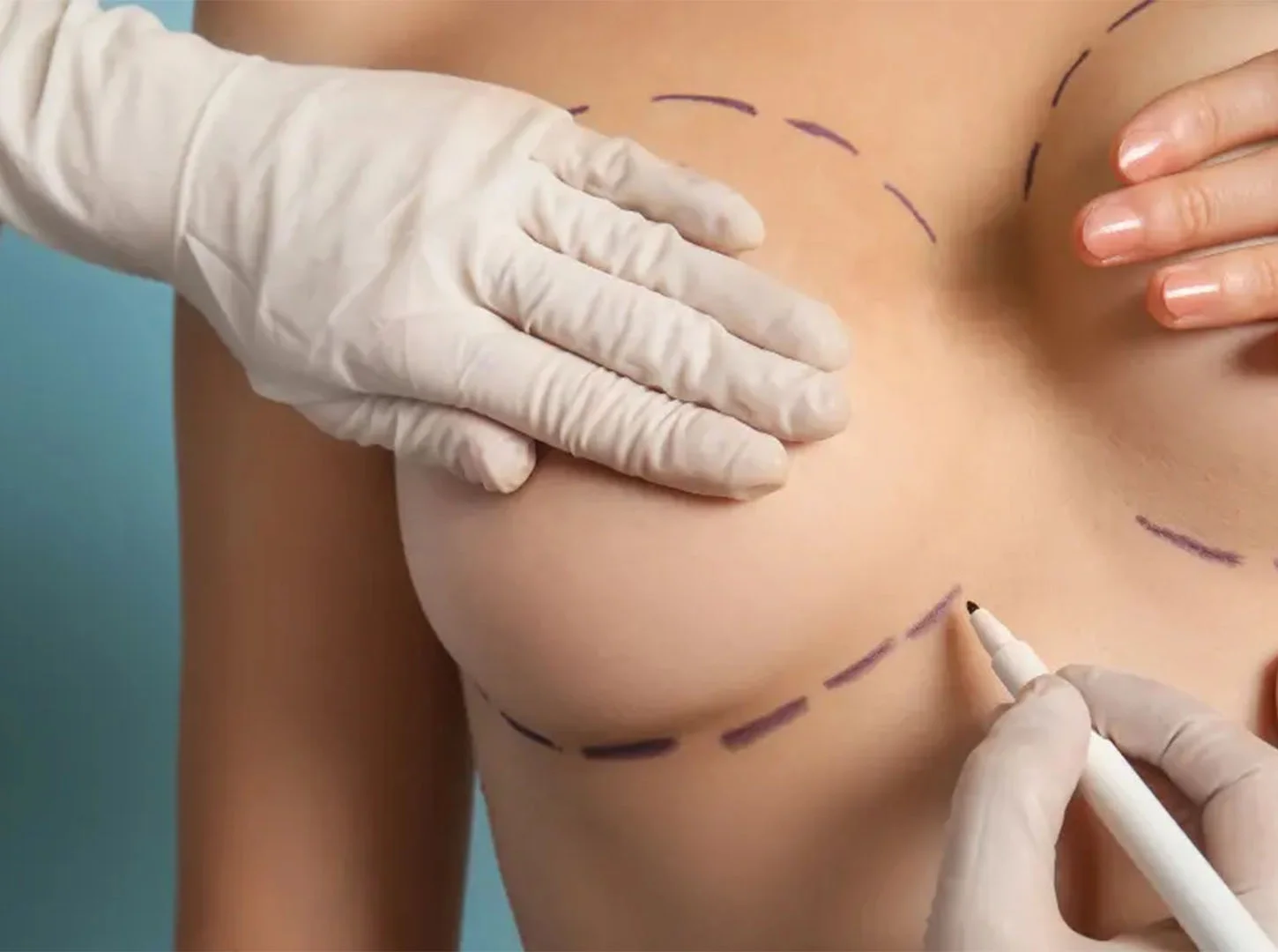 Çfarë është zvogëlimi i gjirit?