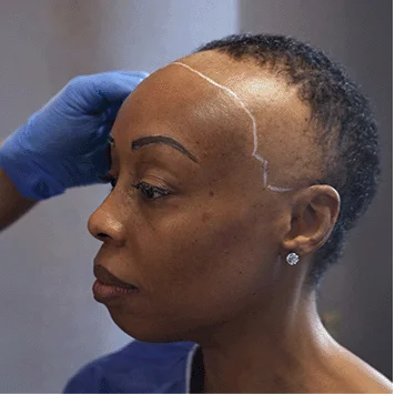 transplante de cabelo para mulheres