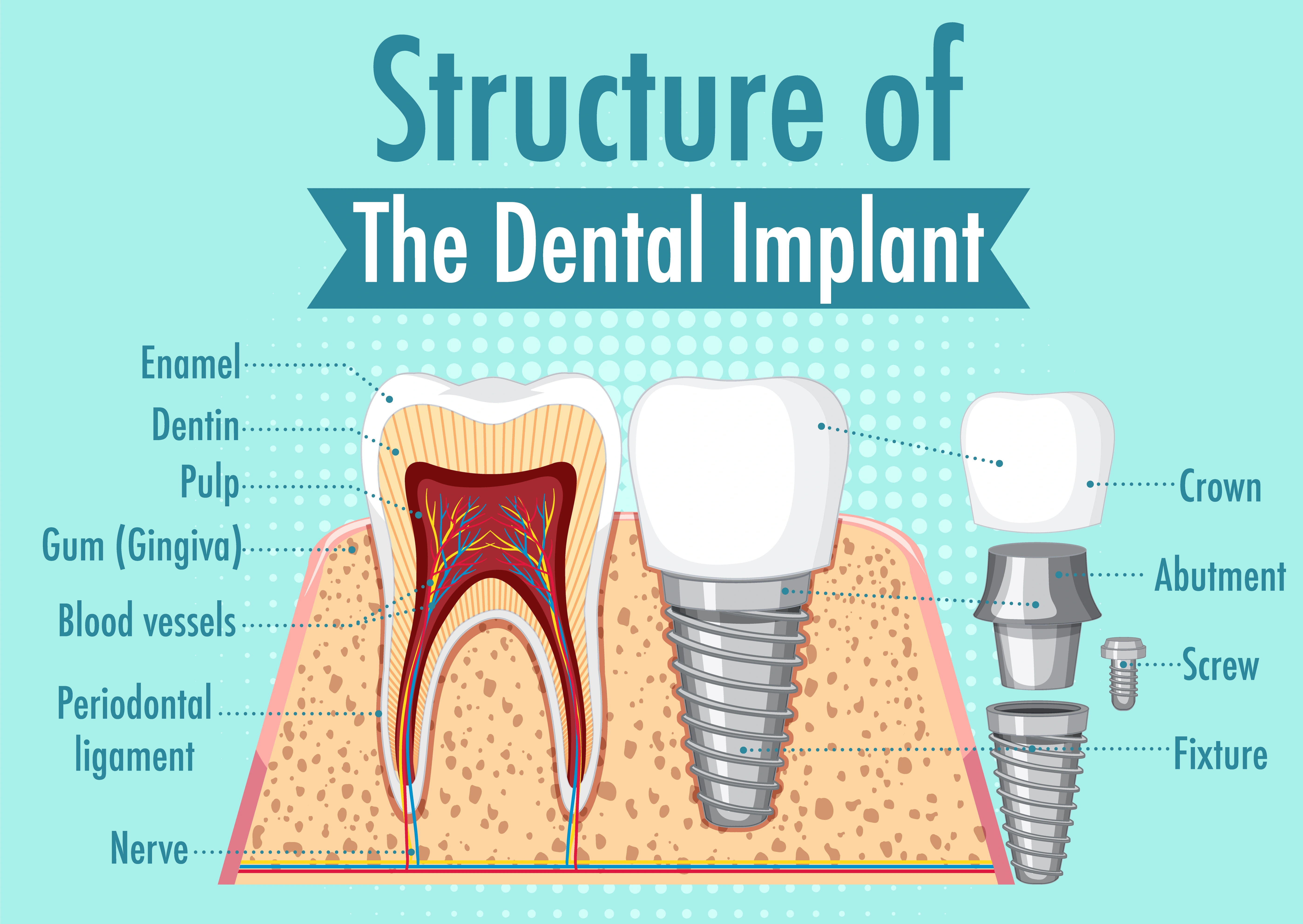 Types of All-on-X Dental Implants