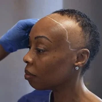 Womans hair transplant