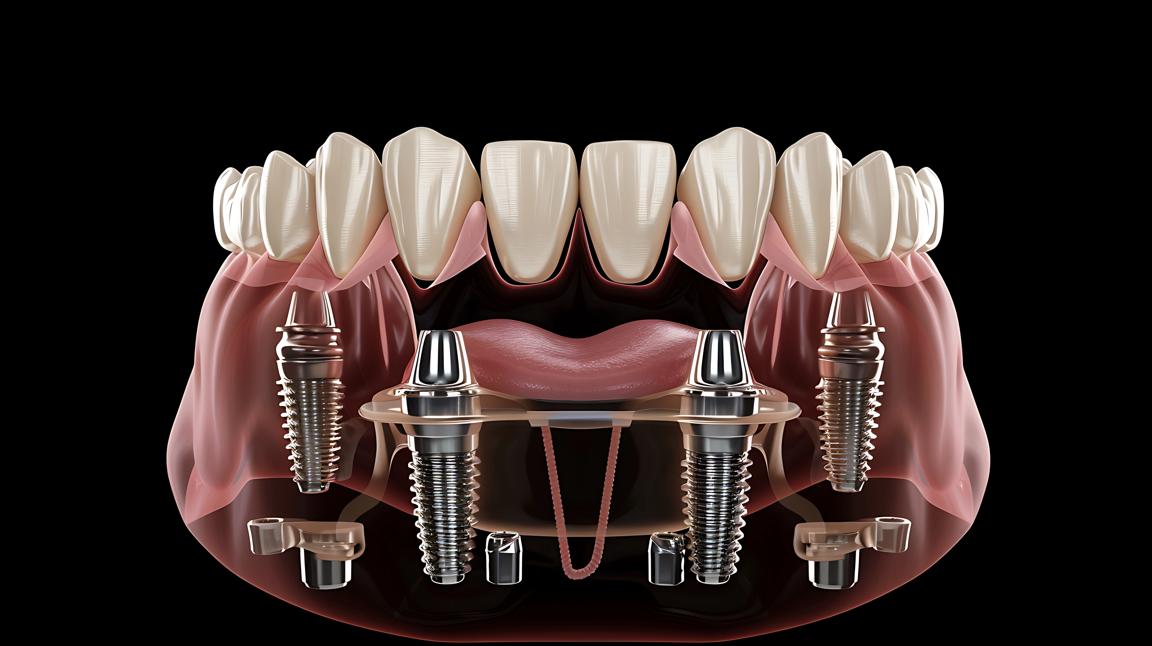 all-on-4-dental-implants
