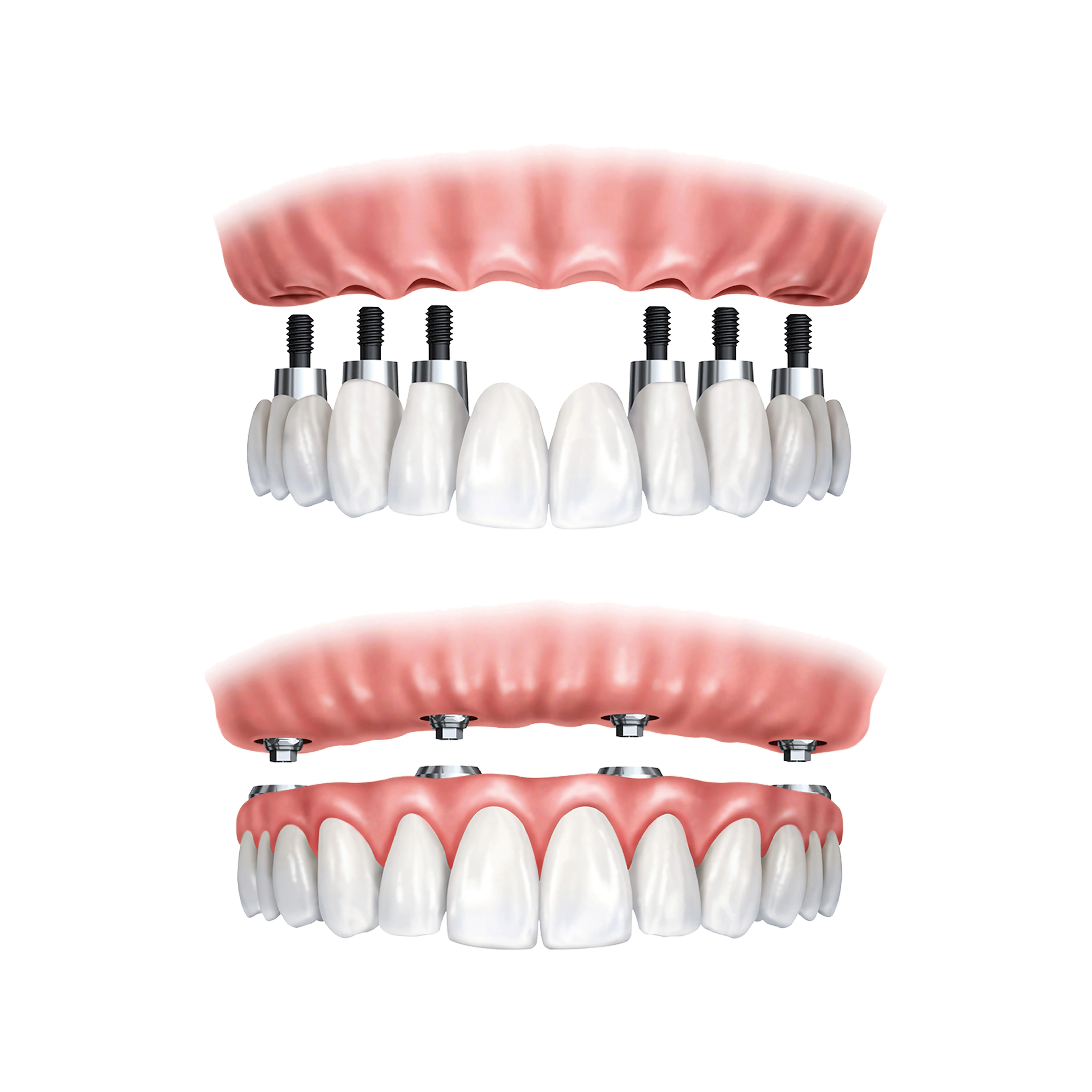 all-on-5-dental-implants