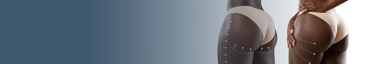 Brazylijski Butt Lift w Turcji