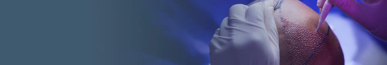 DHI-Haartransplantation