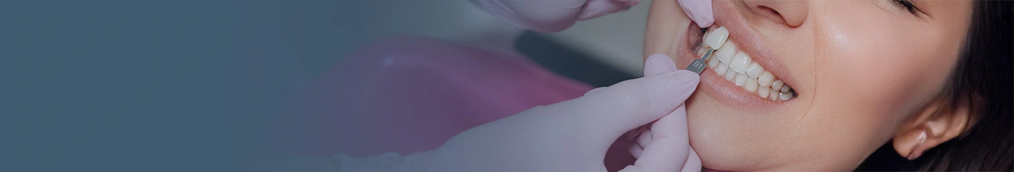 E-max Veneers Turkey