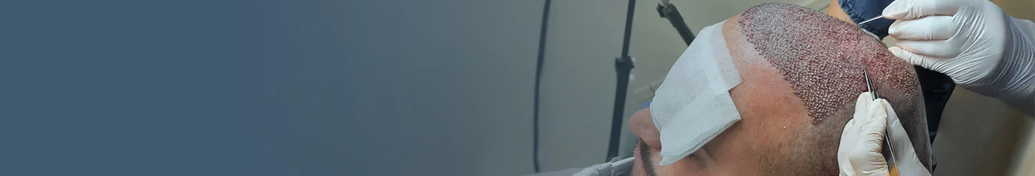 Transplanti i flokëve FUE