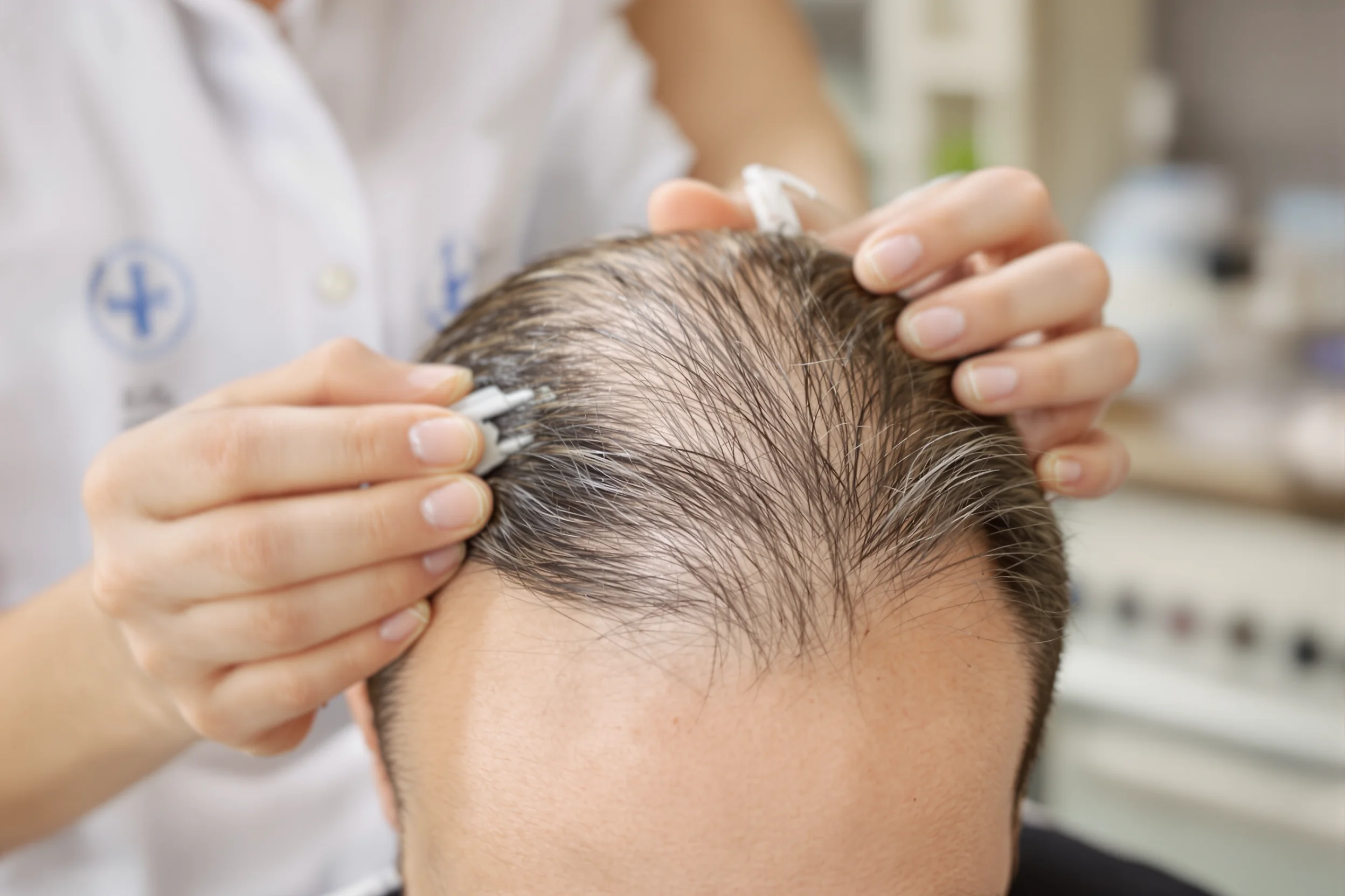 Chirurgie capillaire: guide et solutions modernes